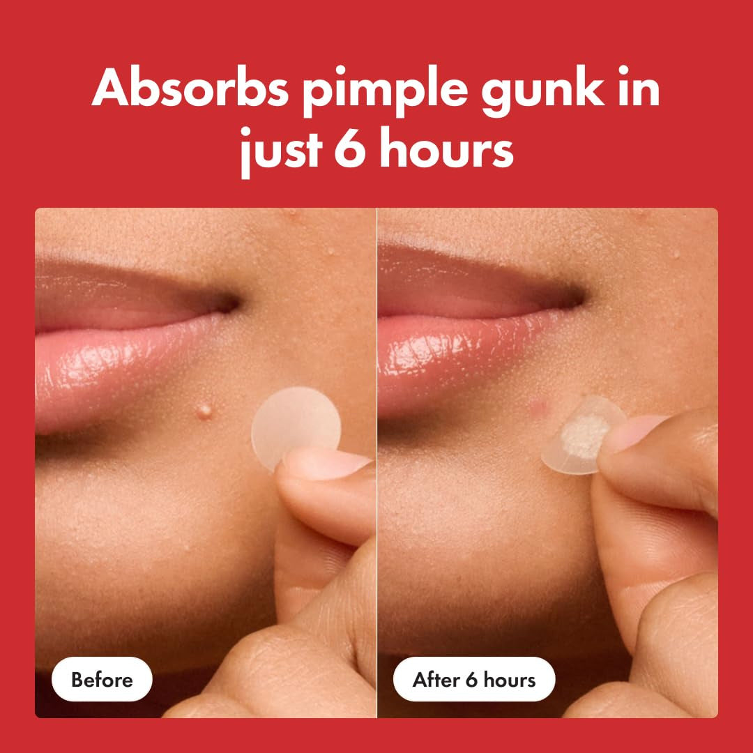 Before and after showing a pimple being absorbed by a patch on skin